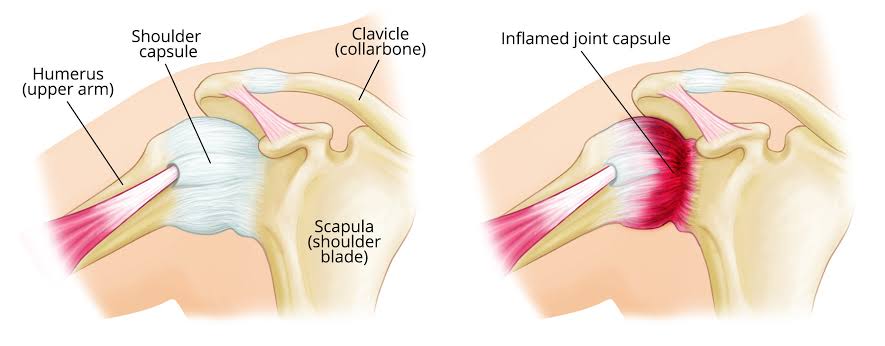 Frozen Shoulder: Why It Happens and How Physiotherapy Restores Movement