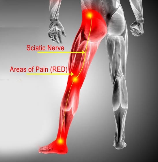 Sciatica: What Causes Leg Pain from the Back and How to Treat It